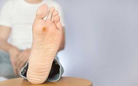Types of warts how warts occur common wart treatments other treatment options recurring warts. Conditions Treatments Singhealth