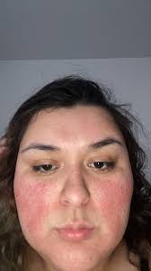 Hello!! I'm a nurse and struggle with rosacea (quite bad). My face is  constantly red and people make it worse when making comments like “are you  sunburnt or have you got a