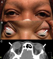 Image result for Dacryoadenitis