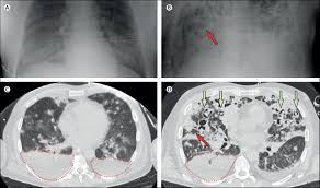 Brain ct and mri findings in 100 consecutive ?patients with intracranial tuberculoma. Invasive Pulmonary Aspergillosis After Near Drowning The Lancet Infectious Diseases