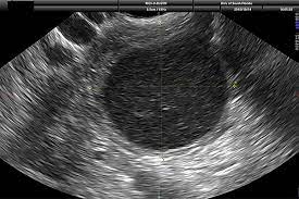 Ovarian cancer can attach to the intestinal tract, causing symptoms that mimic irritable bowel syndrome (ibs). Watchful Waiting With Routine Ultrasound Safer Than Removing Benign Ovarian Cysts Study Suggests Usf Health Newsusf Health News