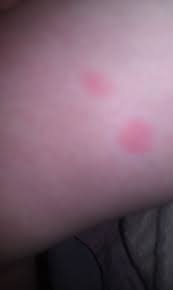 Their bites can result in a number of health impacts including skin rashes, psychological effects, and allergic symptoms. Pictures Of Bed Bug Bites On Kids Bed Bug Bites Bed Bug Bites Pictures Bed Bugs