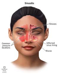 Image result for Sinus Surgery
