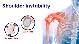 Image result for SLAP Lesion