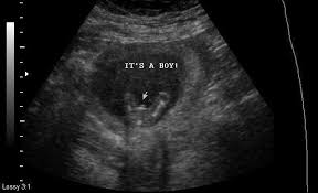 Gender At 14 Weeks January 2020 Babies Forums What To Expect