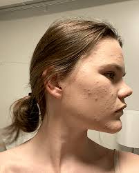 Recension] Spironolakton är livsförändrande. Började ta 2 tabletter varje  dag den 20 januari. De två första bilderna togs den dag jag började, de två  andra togs just nu. Det är bokstavligen det