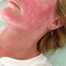 Rosacea Hautarzt Koln Hautarztpraxis Dr Dauer