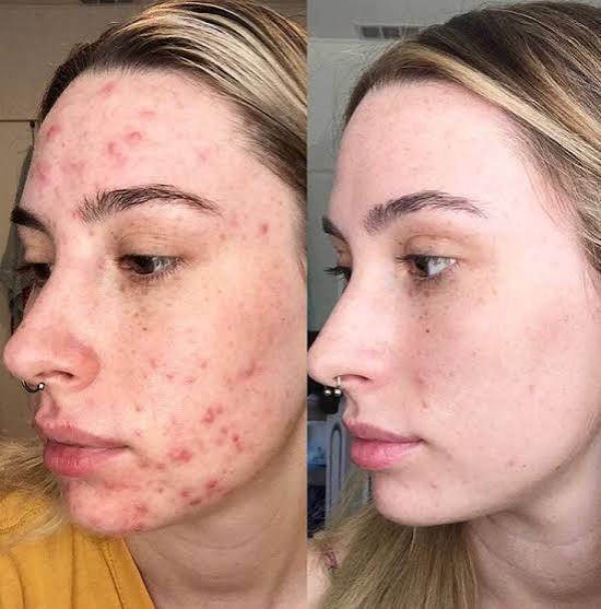 Peeling Acne