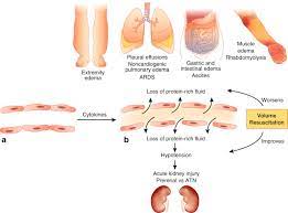 Bei dem nur sehr selten auftretenden leiden ist die durchlässigkeit der kapillargefäße zu hoch, so dass plasma austritt. Capillary Leak Syndrome Etiologies Pathophysiology And Management Kidney International