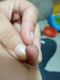 Puntos Blancos En El Pezon Buscando Bebe Babycenter