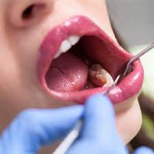 How is oral cancer diagnosed? Things You Should Know About Oral Cancer Laura Elliff Dmd