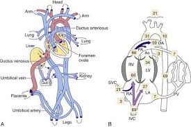 Image result for Delayed Transition from Fetal Circulation