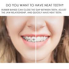 How much does a diastema closure cost? 100 Pcs Dental Rubber Bands Orthodontic Elastics Braces Teeth Gap Shopee Singapore