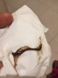 You may also experience other symptoms such as anxiety and stomach pain. Brown Sticky Discharge January 2019 Birth Club Babycenter Australia
