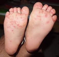 Skin lesions healed within 14 days with slight background to report an uncommon case of hand, foot and mouth disease, (hfmd) in an immunocompetent adult; Hand Foot And Mouth Disease After Hours Kids Physician Assistants