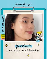Acne Patch secara umum merupakan plester jerawat mengandung hydrocolloid  yang dapat menyerap kelebihan nanah dan sebum pada jerawat.⁣⁣ Acne Patch  dari Derma Angel dapat menyamarkan, menyembuhkan, dan melindungi jerawat.  Ada 2 varian,