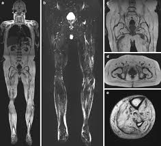 3 enumerate the muscles of true pelvis. Whole Body Imaging Of The Musculoskeletal System The Value Of Mr Imaging Springerlink