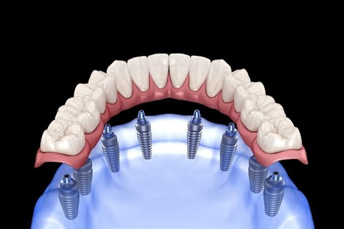 Full Mouth Dental Implants: The Definitive Guide to Total Smile Restoration - Karat Dental Clinic | Dental Clinic Turkey