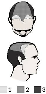 Don't confuse a widows peak with a receding hairline, even if the first signs of baldness match the jamie dornan is full of surprises, especially when it comes to his hair. Losing Hair From One Side Of The Hairline