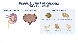Image result for Calcium Nephrolithiasis