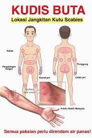 5) membantu menghilangkan parut kudis buta. Public Health Malaysia Sekiranya Ada Ruam Merah Yang Sangat Gatal Pada Lokasi Lokasi Ini Terutamanya Pada Waktu Malam Ia Mungkin Jangkitan Scabies Atau Kudis Buta Jangkitan Ini Mudah Dirawat Dengan Berkesan