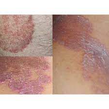 Terdapat beberapa jenis jangkitan kulat pada kulit yang boleh merebak hampir kesemua bahagian badan yang dikenali sebagai jock itch, kurap (ringworm) luka atau lepuhan kulit akan memburukkan lagi jangkitan ini. Krim Kurap Panau Gatal Jangkitan Kulat Shopee Malaysia