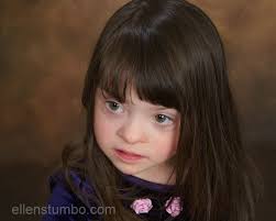 Fold and by nasal bridge augmentation. A Closer Look At The Physical Characteristics Of Down Syndrome Ellen Stumbo