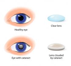 Image result for Cataract Extraction
