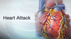 Heart attack first aid Information | Mount Sinai - New York