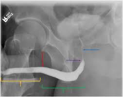 Image result for Retrograde Urethrogram