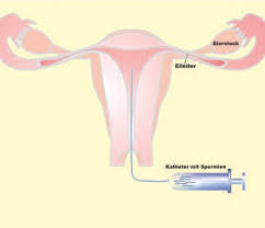10ml), eine stumpfen einführkatheter und die spermaprobe sollte körperwarm sein. Insemination Erfolgschancen Ablauf Und Vorbereitung