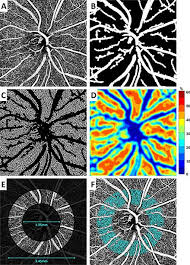 Oct A Detects Early Stage Glaucoma Bioscan Dec 2016