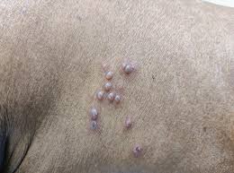 Image result for herpes zoster