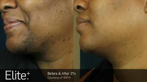 She will also go through a form explaining the in's and out's of laser hair removal so you feel completely comfortable with the treatment. Laser Hair Removal Specialist Lakeland Fl North County Dermatology Clinic Dermatologist