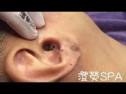 Pin On Dr Pimple Poper