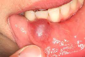 Volle lippen mögen bei hollywoodstars beliebt sein, doch für den rest von uns können geschwollene lippen hinweis auf ein gesundheitliches problem sein. Schwellung An Der Unterlippe Innen Mucocele Zahnnotizen