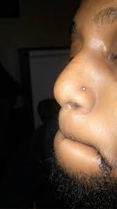Is This Normal Healing For A One Month Nose Piercing I Have A Round Scar Around The Stud And The Stud Is Still Embedded In Hole Piercing