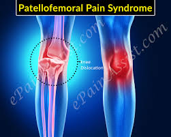 Patellofemoral Pain Syndrome Exercises And Physical Therapy