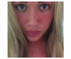 Sonnenbrand Im Gesicht Was Soll Ich Nur Machen