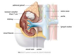 Plus, many possible kidney cancer symptoms, like blood in the urine, can also result from less. Kidney Cancer Patient Information