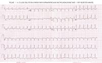 Paroxysmal supraventricular tachycardia (psvt)rob theriault. Supraventricular Tachycardia Ecg Causes Symptoms Treatment