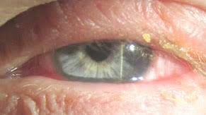 We did not find results for: Eyerounds Org Adenoviral Conjunctivitis