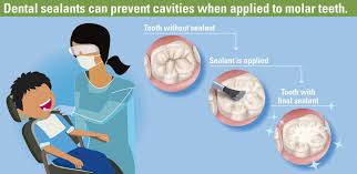Check spelling or type a new query. Should My Child Get Dental Sealants Golden Pediatric Dentistry Orthodontics