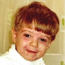 Comparison Chart of Systemic Autoinflammatory Diseases (SAID) Involving  Periodic Fevers