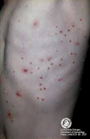 Human monkeypox is a viral zoonotic disease that occurs mostly in the rain forests of central and western africa. Update Since The Eradication Of Smallpox The Most Alarming Developments Have Been The Rise In The Cases Of Genital Molluscum Contagiosum It Is Believed That The Prevalence Of Molluscum Contagiosum Has Increased As An Opportunistic Infection Due To