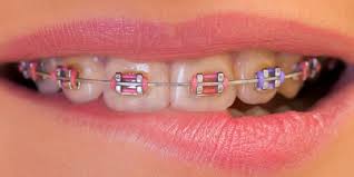Check spelling or type a new query. Braces Trend Atau Keperluan 5 Perkara Ini Anda Perlu Tahu Sebelum Pakai Braces Semua Semua Semuanya