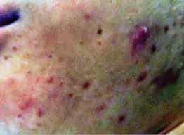 Tips sembuh dari gerd dan anxiety part 2. January 2017 Bella Idura