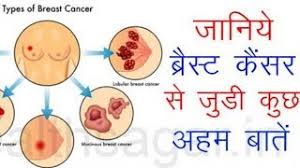 क्योंकि यह जानलेवा तो है हीं, और बच जाने पर भी स्तनों को ऑपरेशन के जरिये निकलना पड़ता है. Breast Cancer Symptoms And Treatment In Hindi Youtube