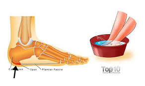 A Heel Spur Occurs When Calcium Deposits Build Up On The Underside Of The Heel Bone The Abnormal Calcium D Heel Spurs Heel Spurs Treatment Heel Spurs Remedies