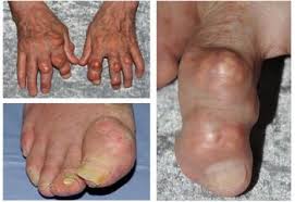 Image result for gout